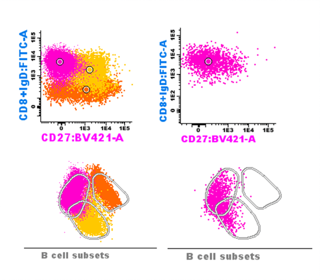 Dot plots and comparative PCA representations for B cell subsets in a healthy subject and a patient with Common Variable Immunodeficiency (CVID).